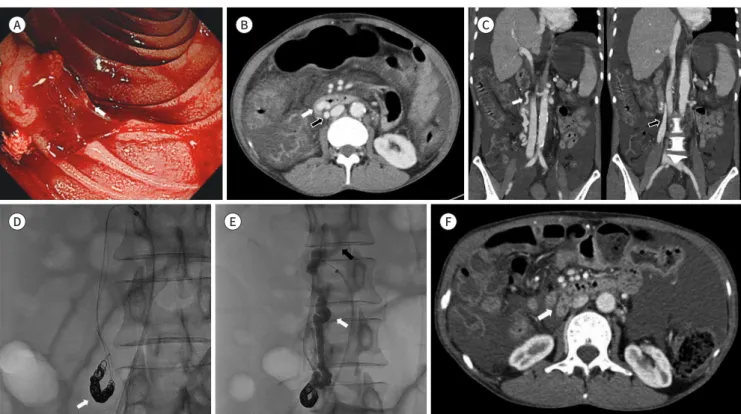 Fig. 1. A 50-year-old woman with massive hematemesis.