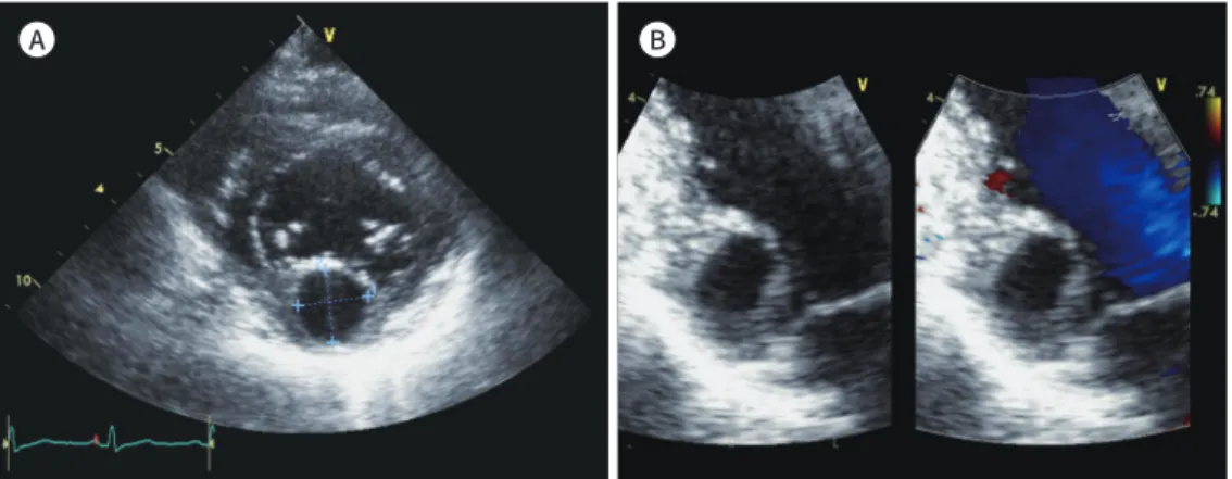 Fig. 1. A giant intramyocardial aneurysm with intercoronary communication in a 43-year-old woman, pre- pre-senting with palpitation for 2 months.