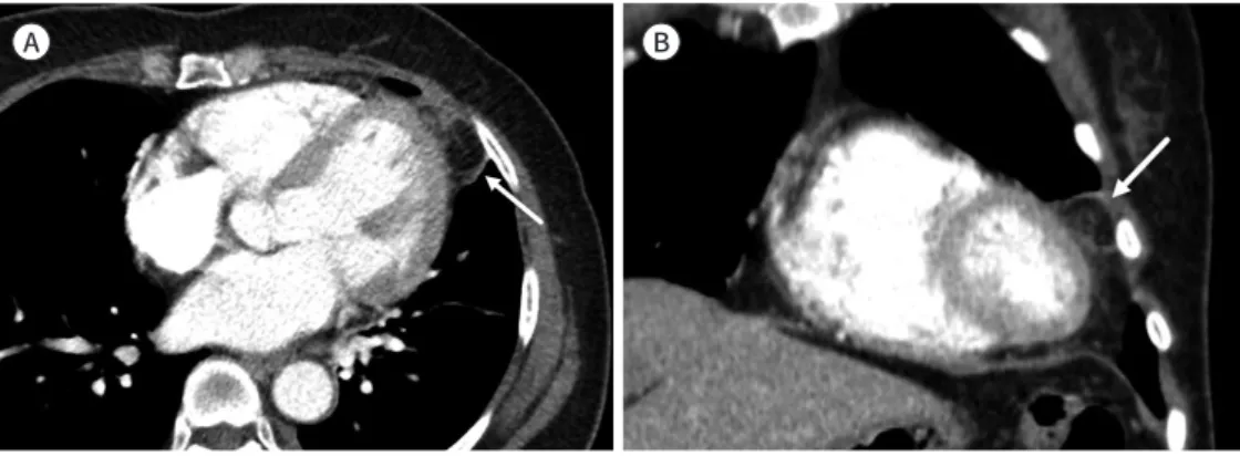 Fig. 13. Pericardial cyst.