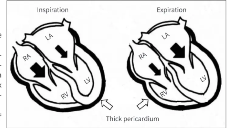 Fig. 4. Ventricular interdependence  with constrictive pericarditis.