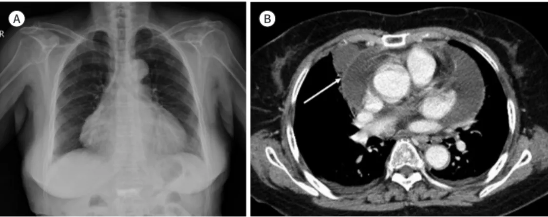 Fig. 6. Pericardial effusion with tuberculosis. 