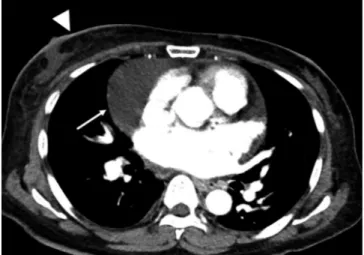 Fig. 9. Pericardial effusion after radia- radia-tion treatment for breast cancer.