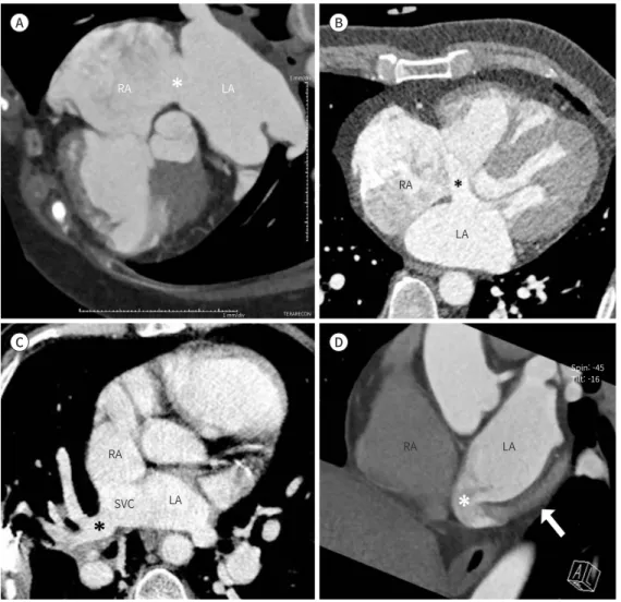 Fig. 11. Four types of ASDs.