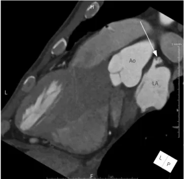 Fig. 12. Accessory left atrial append- append-age in a 48-year-old man.