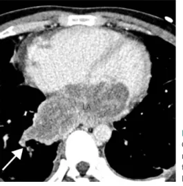 Fig. 6. Metastatic osteosarcoma in a 28-year-old man.  