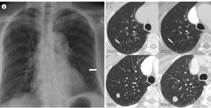 Fig. 1. Adenofibromas of the lung in a 71-year-old woman.