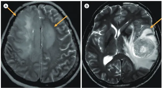 Fig. 1. A non-enhancing infiltrative tumor portion in the peri-enhancing lesion on T2-weighted images helps  to distinguish a primary from a secondary central nervous system tumor