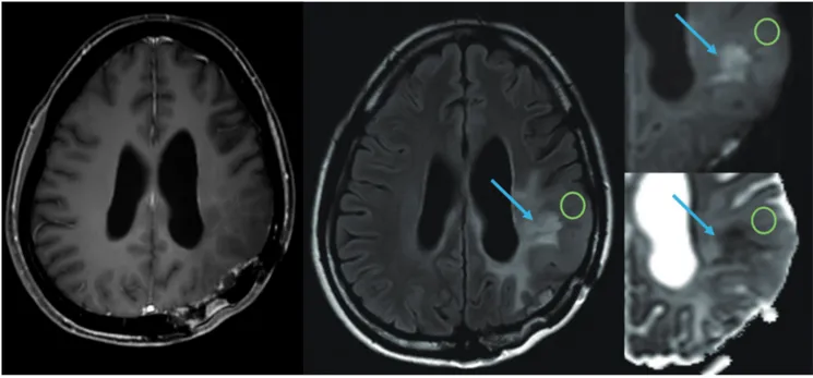 Fig. 3. A 61-year-old male with recurrent glioblastoma who underwent anti-angiogenic therapy