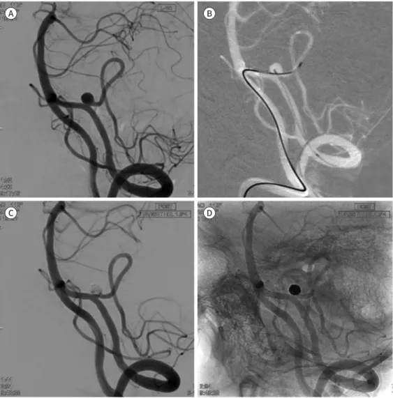 Fig. 6. Contralateral vertebral artery approach for stenting the left posterior inferior cerebellar artery in a  67-year-old woman.