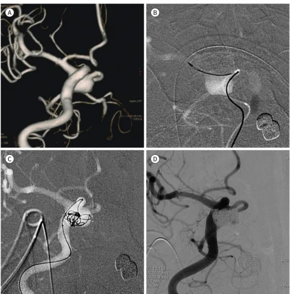 Fig. 5. Retrograde stenting from the distal internal carotid artery to the posterior communicating artery for  assisting coil embolization of a right posterior communicating artery aneurysm in a 65-year-old man.