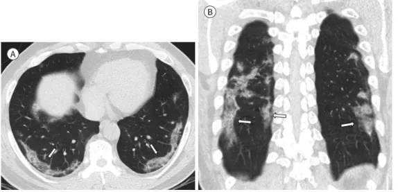 Fig. 3. A 23-year-old man with coronavirus disease 2019 pneumonia in the mild group. 