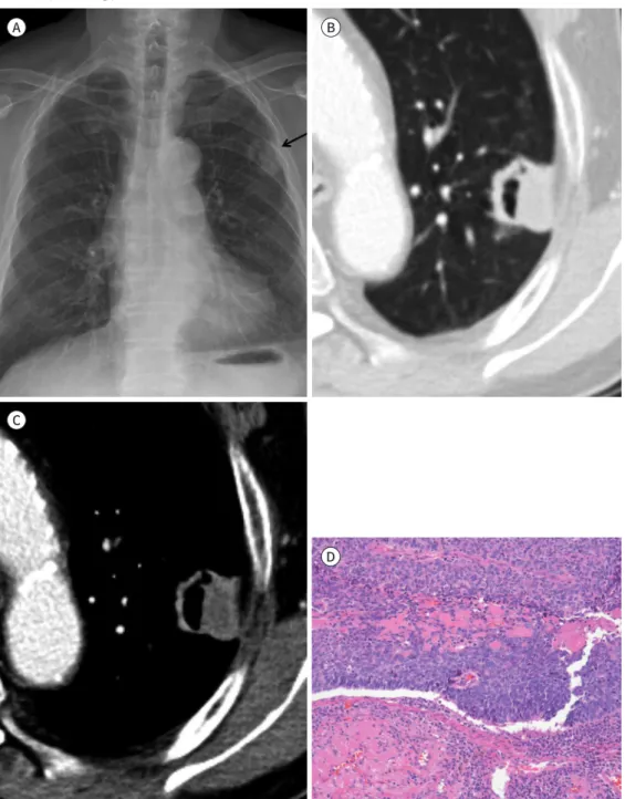 Fig. 1. An 85-year-old man with basaloid squamous cell carcinoma of the lung. 