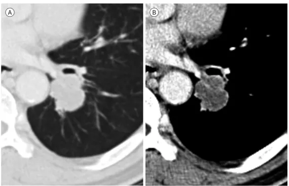 Fig. 2. A 68-year-old man with basaloid squamous cell carcinoma of the lung. 