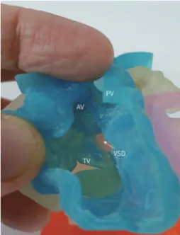 Fig. 2. Three-dimensional printed model of the heart of a patient with double-outlet right  ventricle patient (arrow, VSD).