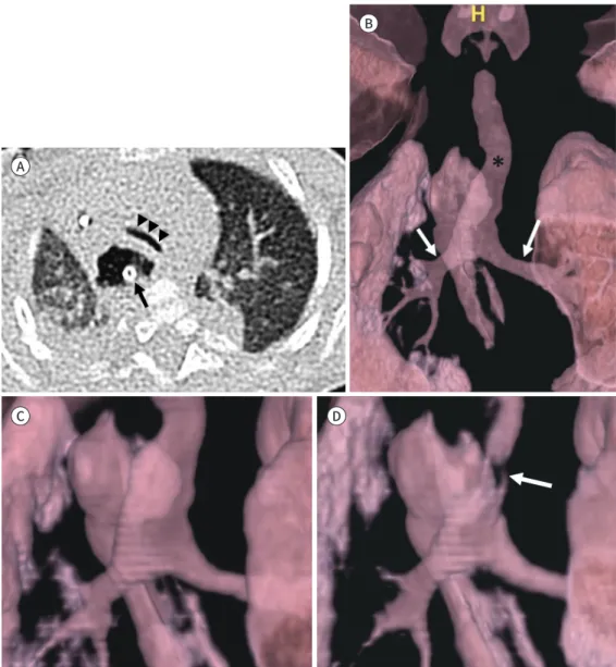 Fig. 9. A 5-month-old boy with tracheomalacia.
