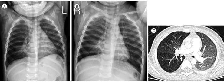 Fig. 11. A 13-month-old boy with foreign-body aspiration.