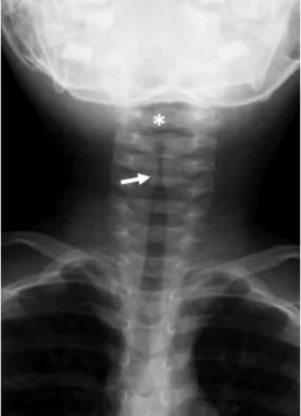 Fig. 8. A 2-year-old girl with croup.