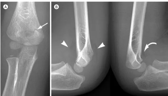 Fig. 11. Type 1 supracondylar fracture. 