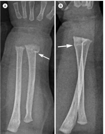 Fig. 2. Buckle fracture.