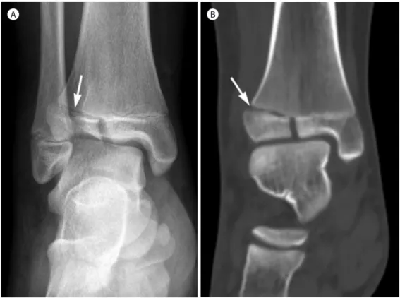 Fig. 6. Tillaux fracture (type 3 Salter-Harris injury) in a 10-year-old child. 