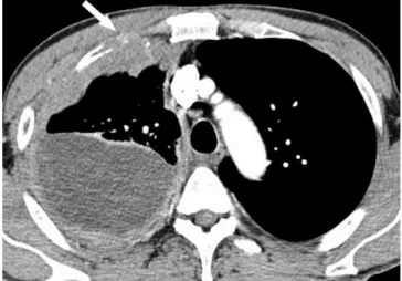 Fig. 3. Malignant mesothelioma in a  71-year-old man.