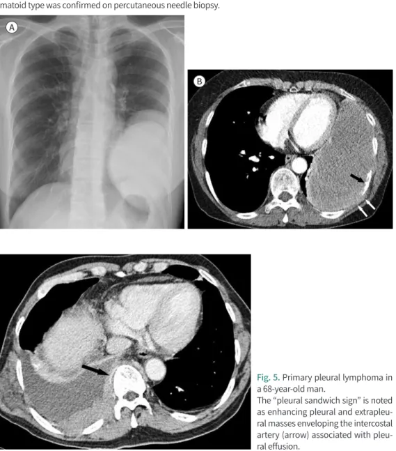 Fig. 5. Primary pleural lymphoma in  a 68-year-old man. 