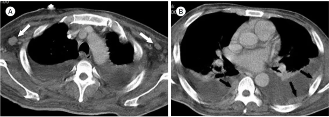 Fig. 8. A 36-year-old man with acute lymphocytic leukemia.