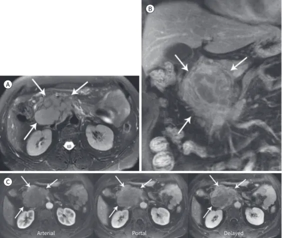 Fig. 11. A 60-year-old woman with inflammatory pseudotumor in the pancreatic head.