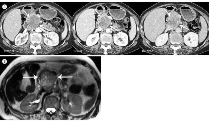 Fig. 4. A 74-year-old woman with pancreatic leiomyosarcoma in the pancreatic head.