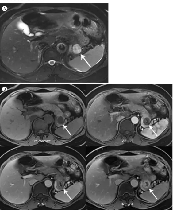 Fig. 5. A 66-year-old woman with pancreatic schwannoma in the pancreatic tail.