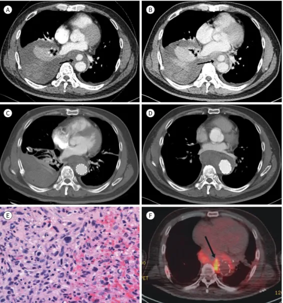 Fig. 1. Undifferentiated pleomorphic sarcoma of the thoracic aorta presenting as ruptured saccular aneu- aneu-rysm in a 53-year-old male with back pain.