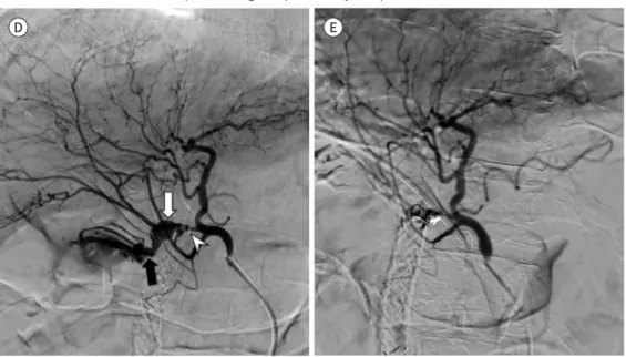 Fig. 1. Delayed hepatic artery hemorrhage caused by biliary stent after concurrent chemoradiotherapy in a  55-year-old man with pancreatic head cancer.