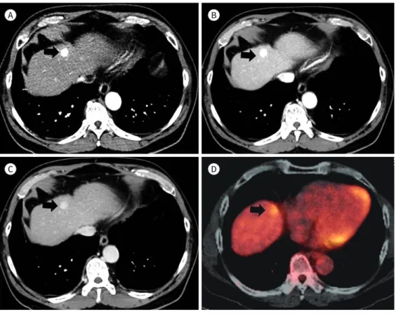 Fig. 3. Combined hepatocellular cholangiocarcinoma with type II enhancement pattern in a 58-year-old man.