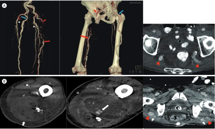 Fig. 1. A 70-year-old man with bilateral PSAs, incidentally detected on CTA and treated with angiographic embolization.