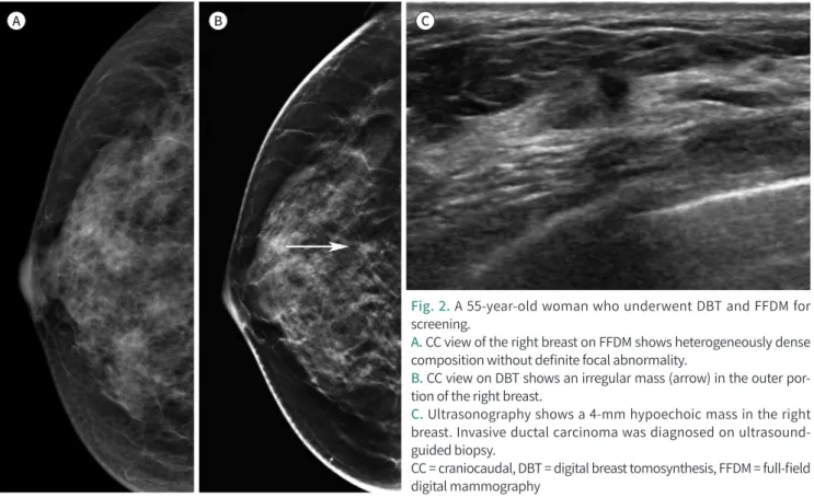 Fig. 2. A 55-year-old woman who underwent DBT and FFDM for  screening. 