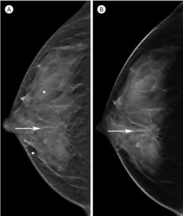 Fig. 4. A 45-year-old woman with invasive ductal carcinoma. 