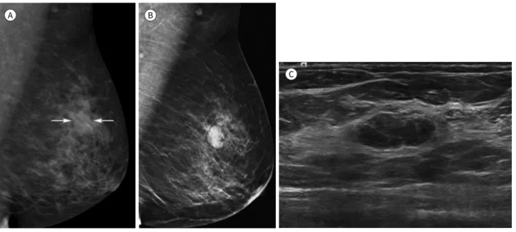 Fig. 6. A 46-year-old woman with invasive ductal carcinoma. 
