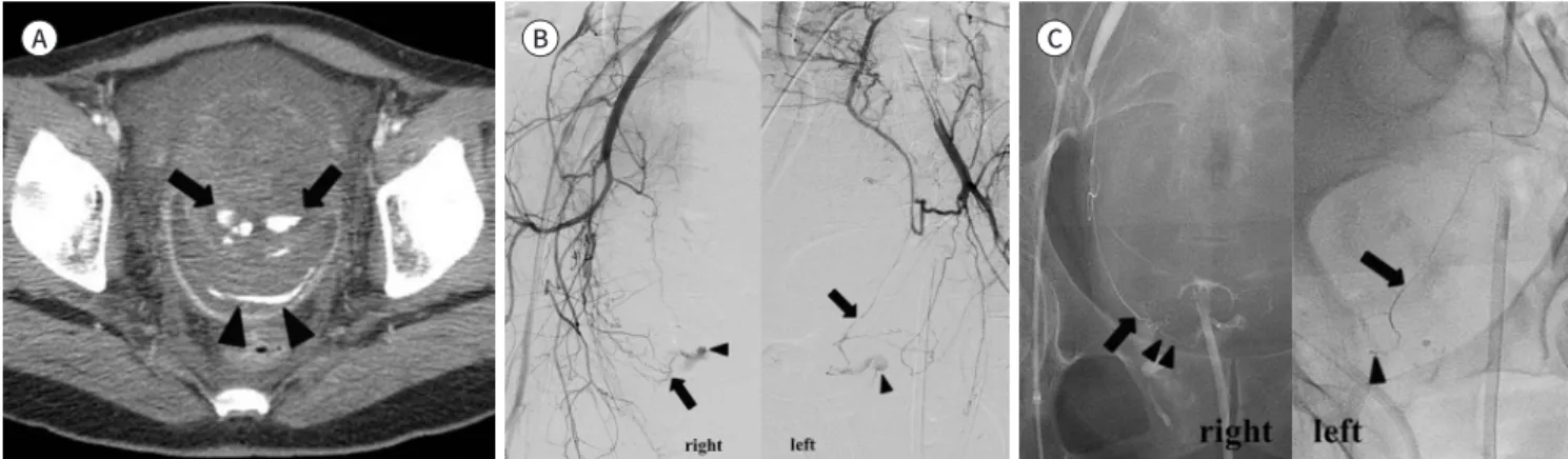 Table 2. Angiographic Findings and the Results of Embolization