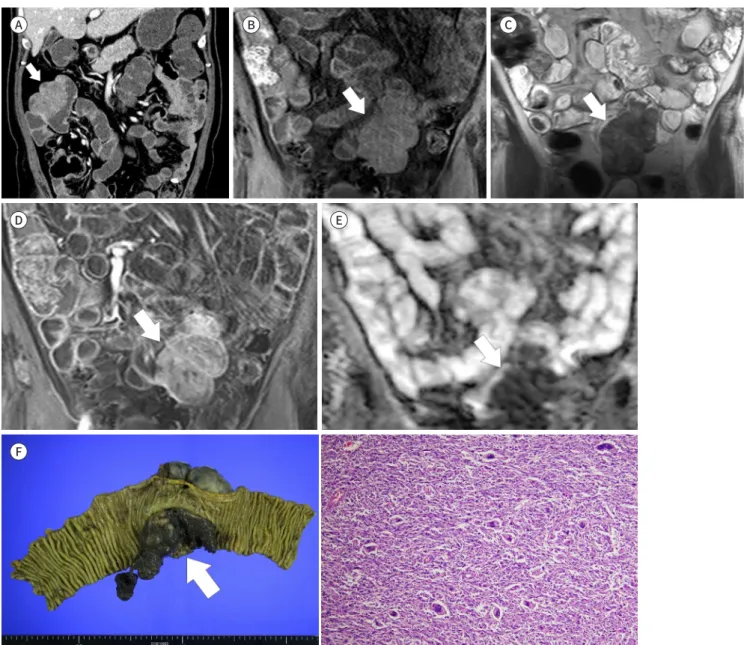 Fig. 1. Primary undifferentiated pleomorphic sarcoma of the small bowel in a 72-year-old male patient.