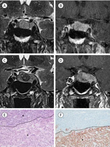 Fig. 1. A 72-year-old man with HCC metastasis to pituitary adenoma  presenting with oculomotor nerve palsy.