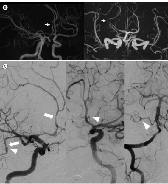 Fig. 1. HIV-associated multiple cerebral aneurysmal vasculopathy in a 34-year old man, presenting with left  side weakness and tingling sensation in left leg and cheek.