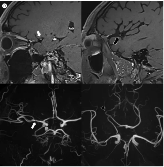 Fig. 1. HIV-associated multiple cerebral aneurysmal vasculopathy in a 34-year old man, presenting with left  side weakness and tingling sensation in left leg and cheek.