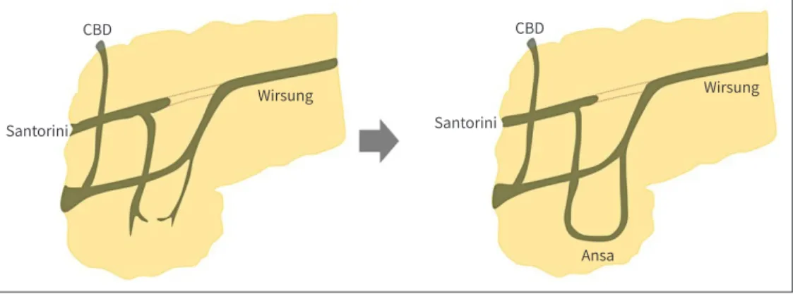 Fig. 1. Development of ansa pancreatica type anatomic variation. A curved additional duct is formed in  ansa pancreatica replacing atrophied accessory duct during pancreatic duct development