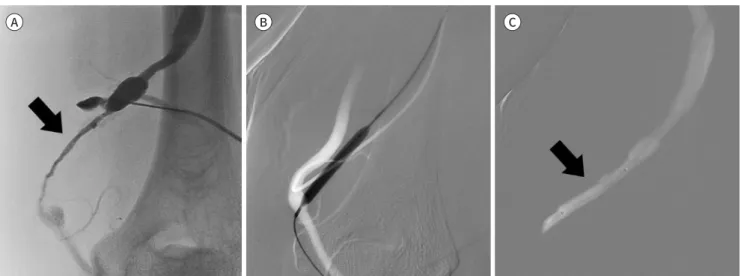 Fig. 2. A 64-year-old man with technically successful percutaneous transluminal angioplasty.