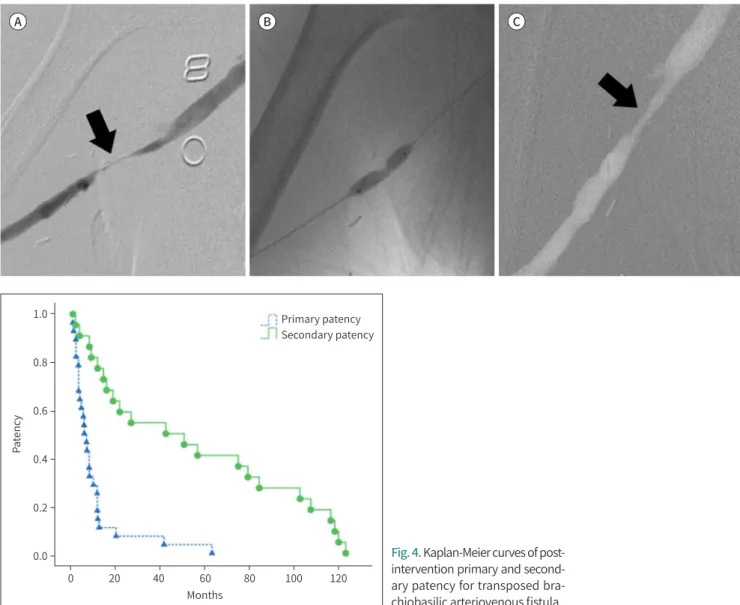 Fig. 3. A 63-year-old woman who underwent a technically failed but clinically successful percutaneous transluminal angioplasty.