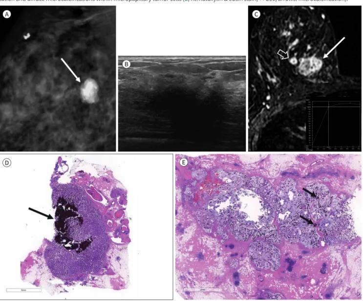 Fig. 1. A 50-year-old woman with a mixed-type mucinous carcinoma. 