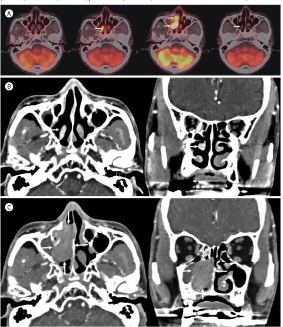 Fig. 1. A 71-year-old man with DLBCL of the MT detected using  18 F-FDG PET/CT that was performed for me- me-tastasis work-up of HCC.