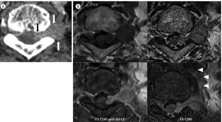 Fig. 1. Extraskeletal Ewing’s Sarcoma in a 73-year-old female.