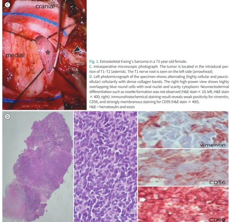 Fig. 1. Extraskeletal Ewing’s Sarcoma in a 73-year-old female.
