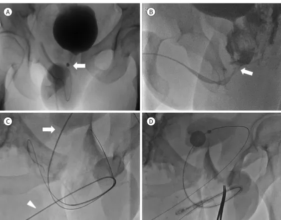 Fig. 3. Interventional realignment for posterior urethral disruption. A 32-year-old man with posterior ure- ure-thral disruption after a motocycle accident.